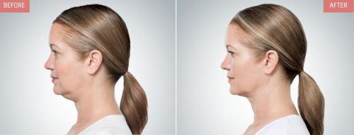 kybella-before-after-boise5