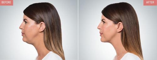 kybella-before-after-boise7
