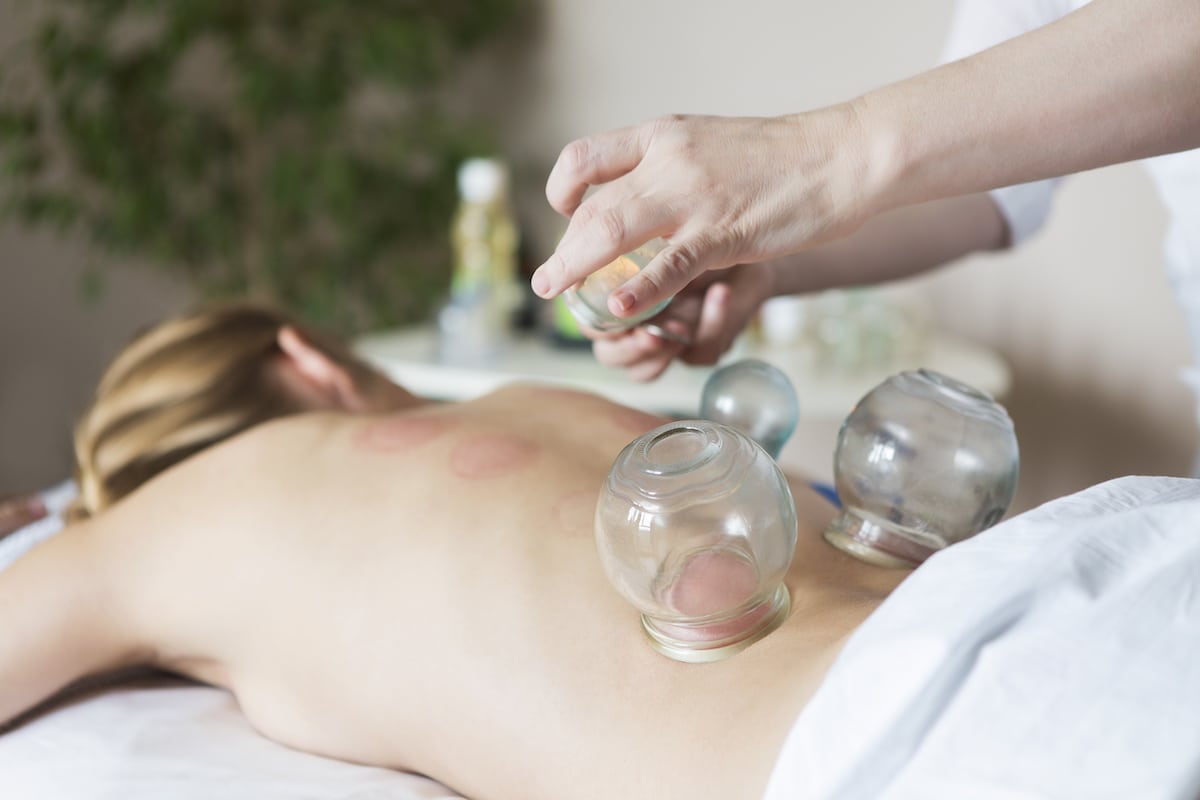 8 Benefits of Cupping Therapy? - REJUV Medspa