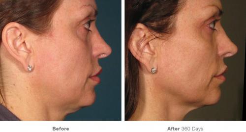 before_after_ultherapy_results_full-face