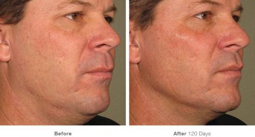 before_after_ultherapy_results_full-face11