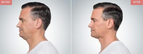 kybella-before-after-boise3