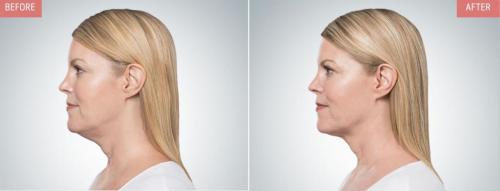 kybella-before-after-boise6