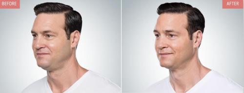 kybella-before-after-boise8
